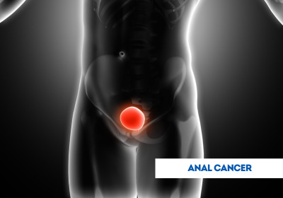Anal Cancer Treatment in India