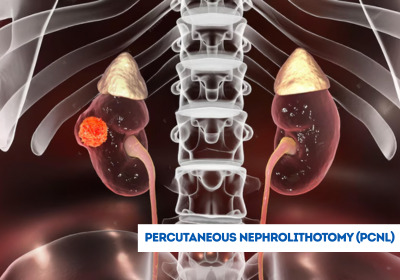 Percutaneous Nephrolithotomy (PCNL) Surgery in India