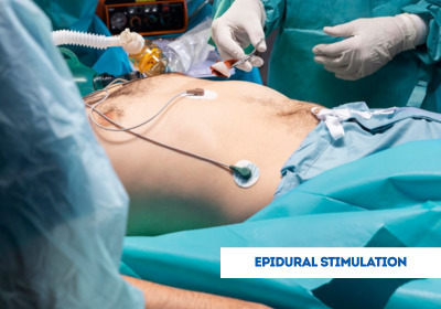 Epidural Stimulation Surgery in India