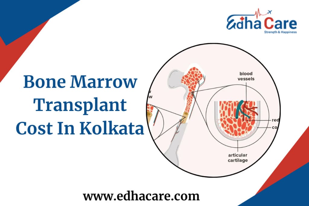 Bone Marrow Transplant Cost In Kolkata