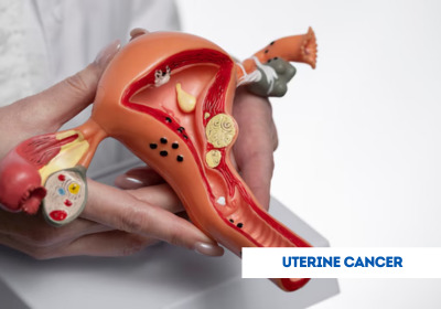 Uterine Cancer Treatment in India