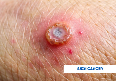 Skin Cancer Treatment in India