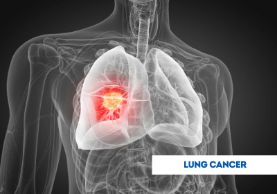 Lung Cancer Treatment in India