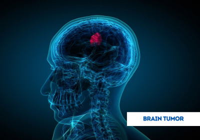 Brain Tumor Treatment in India