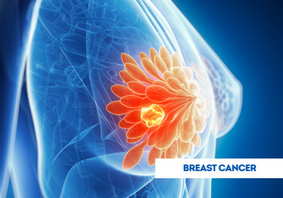 Top Doctors for Breast Cancer Treatment in India