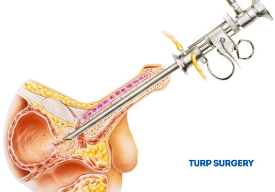 TURP Surgeryin India